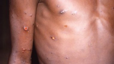 Here Are The Latest Updates About Monkeypox Outbreak